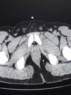 UYUŞTURUCUYU MİDESİNDE GETİRMİŞ