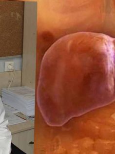 HER 4 KİŞİDEN BİRİNDE GÖRÜLEN KARACİĞER YAĞLANMASI NEDİR?