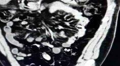 MİDELERİNDE 100 PAKET UYUŞTURUCU İLE OTOGARDA YAKALANDILAR