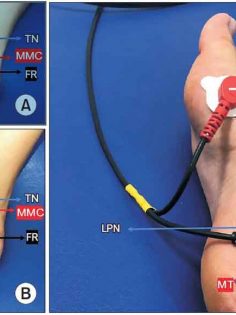 İDRAR KAÇIRMA TEDAVİSİNDE DÜNYA’DA BİR İLK