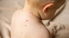 ÇOCUĞUNUZUN BACAĞI KIZARIYORSA HSP OLABİLİR