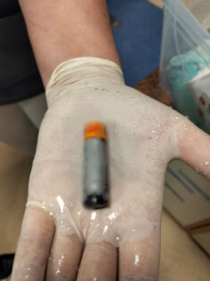 MİDESİNDEN PİL ÇIKTI